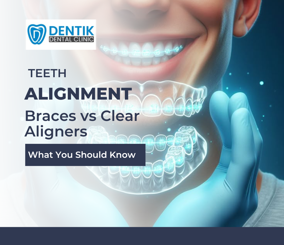 Teeth Alignment Braces vs Clear Aligners — What You Should Know