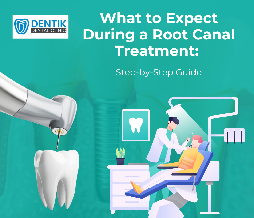What to Expect During a Root Canal Treatment Step-by-Step Guide