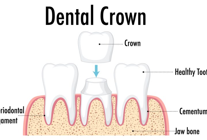 Infographic of human in dental crown illustration